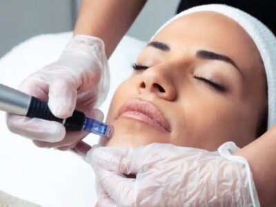 Microneedling