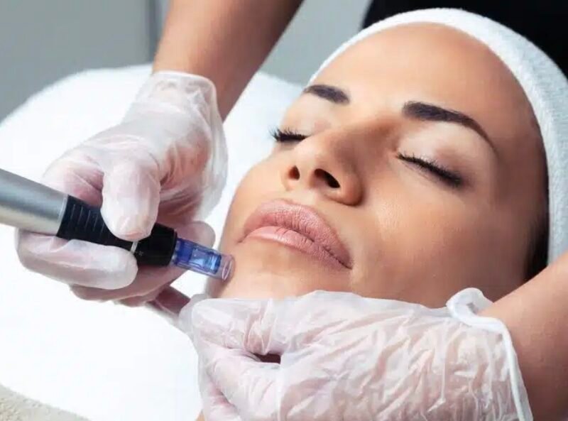 Microneedling